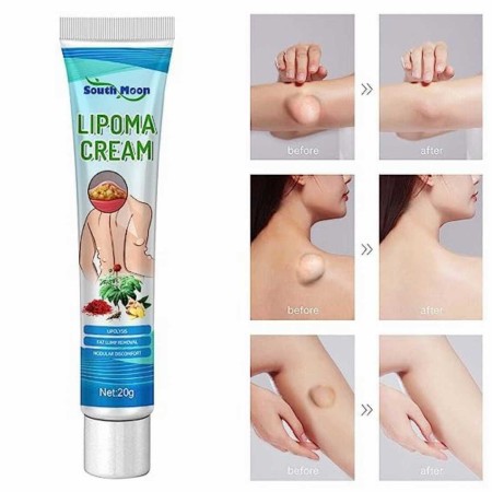 Lipoma Removal Cream-লাইপোমা রিমুভাল ক্রিম
