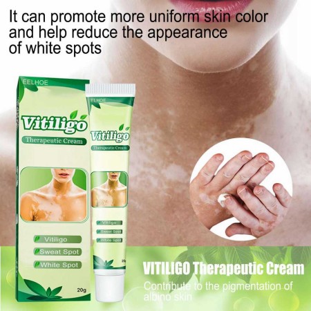 Sumifun Vitiligo Care Cream